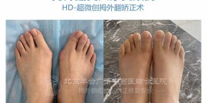 牛江红：什么程度可以做拇外翻手术?——北京丰台广济医院